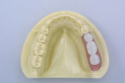 インプラント義歯（自費）